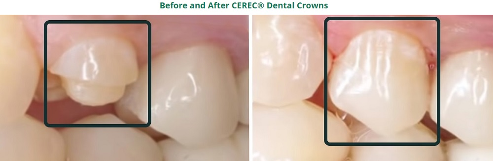 Teeth Before and After CEREC Crown