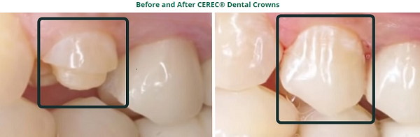 Cerec crowns best dentist in Dousman, Wisconsin
