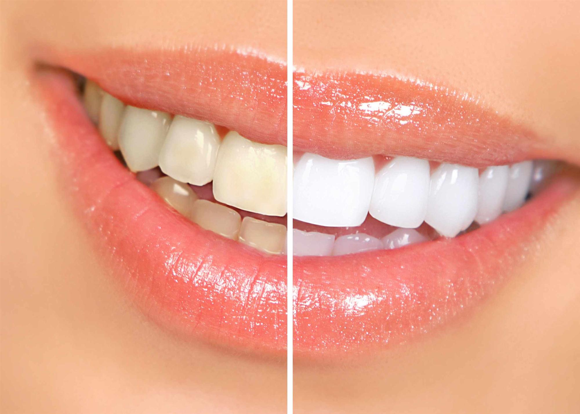 Teeth Whitening Dousman Delafield Waukesha Lake Country