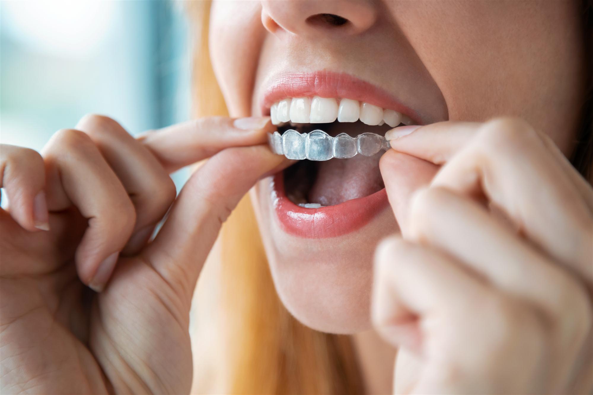 Invisalign clear braces in Wisconsin