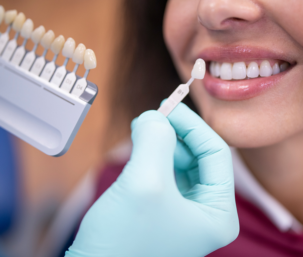 Composite dental veneers in Waukesha County