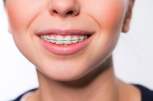 Traditional braces can correct bites and straighten teeth Braces for Dousman Patients Jefferson Lake Country