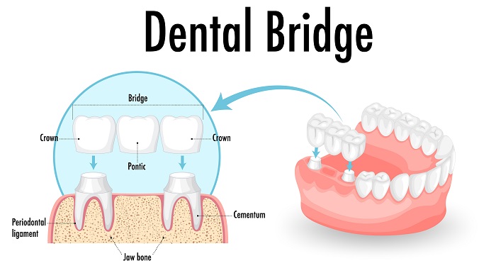Should you choose Dental Bridges or Crowns for the perfect smile
