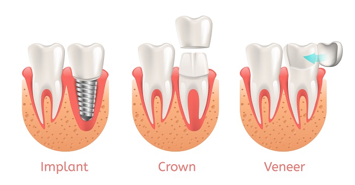Dental Veneers vs Crowns, which is right for you